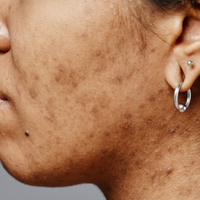 Pigmentation