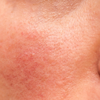Dry Skin
