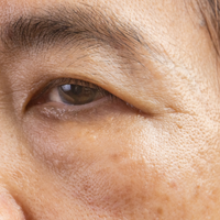 Dark Spots